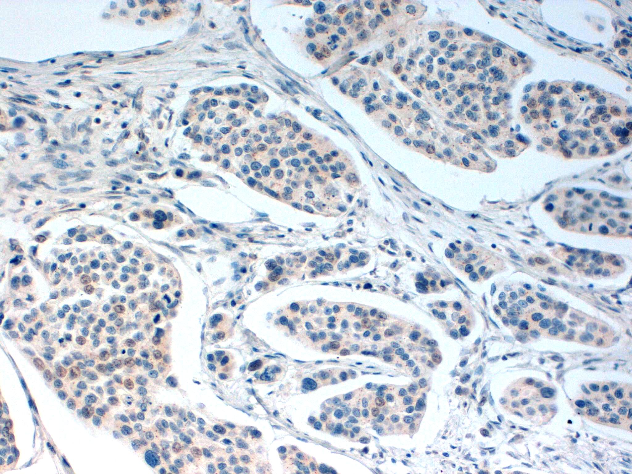 Immunohistochemical staining of FFPE human bladder tissue using Histone H2A.x antibody at 5 µg/ml and antigen retrieval at pH 6.2.  Visualization using goat anti-rabbit HRP secondary antibody and DAB substrate.  Pathologists Comments: Excellent nuclear staining on bladder.  pH 9.5 staining shows better nuclear staining of the neoplastic cells.